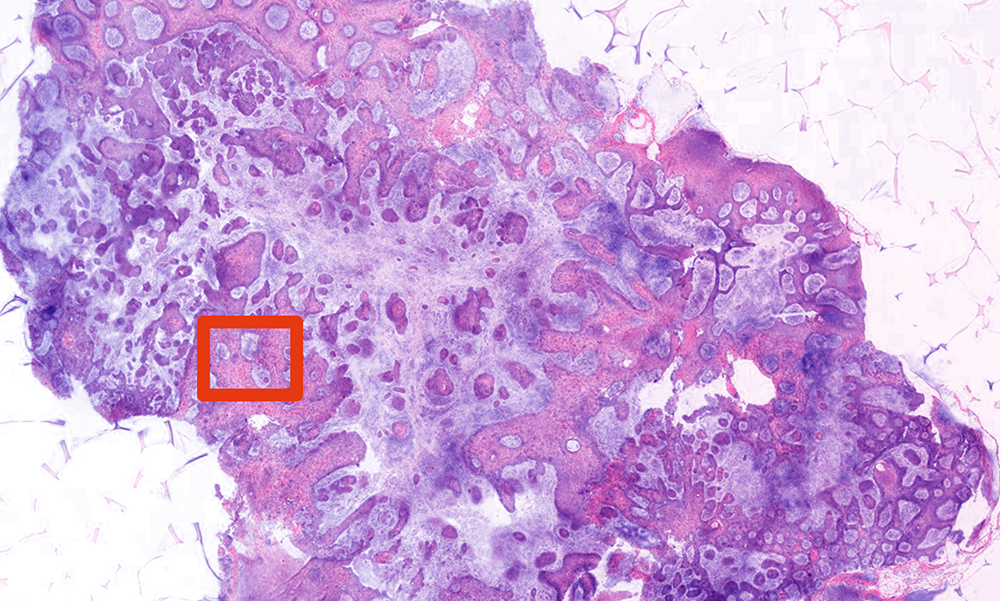 Tissue biopsied with a novel imaging system based on 2-photon fluorescence microscopy (TPFM) is showing promising results.