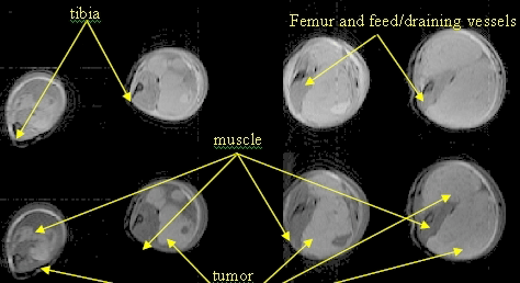 tumor pathology