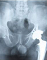 X-ray of hipbone 