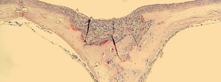 osteolysis