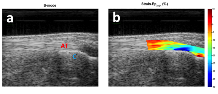 Achilles tendon-calcaneus