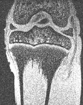 knee joint MRI