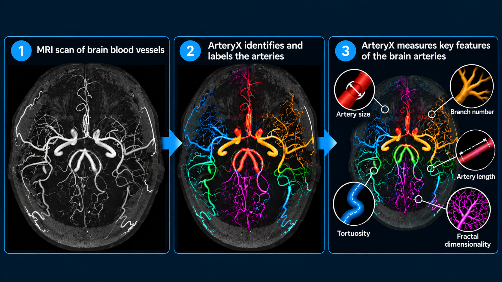 URochester Medicine researchers Giovanni Schifitto, MD, Abrar Faiyaz, PhD, and Nasir Uddin, PhD, collaborated to create ArteryX.