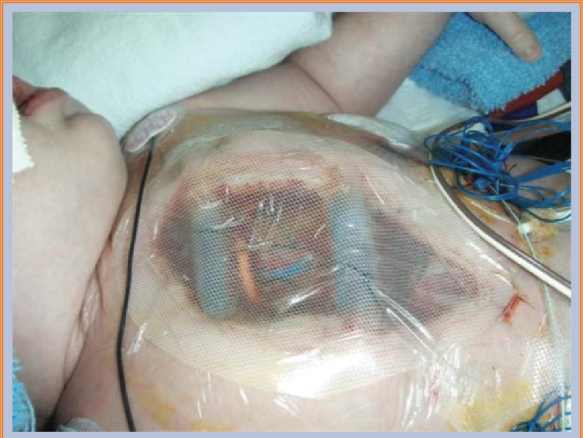 infant with an open sternum covered with a sterile occlusive dressing