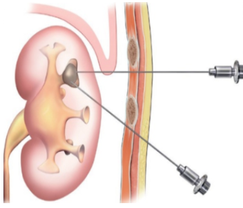 Figure 2. PCNL surgery by X-ray to remove kidney stone.